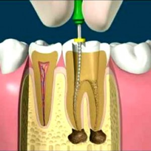 Endodoncia Dental.