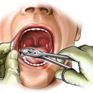 Cirugìas Dentales.